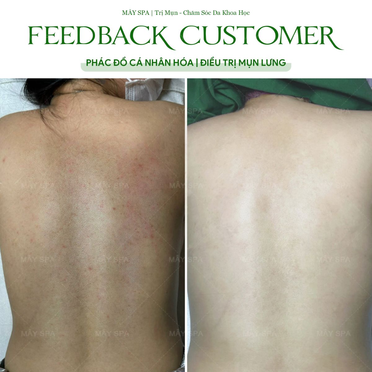 Kết quả liệu trình trị mụn lưng tại Mây Spa
