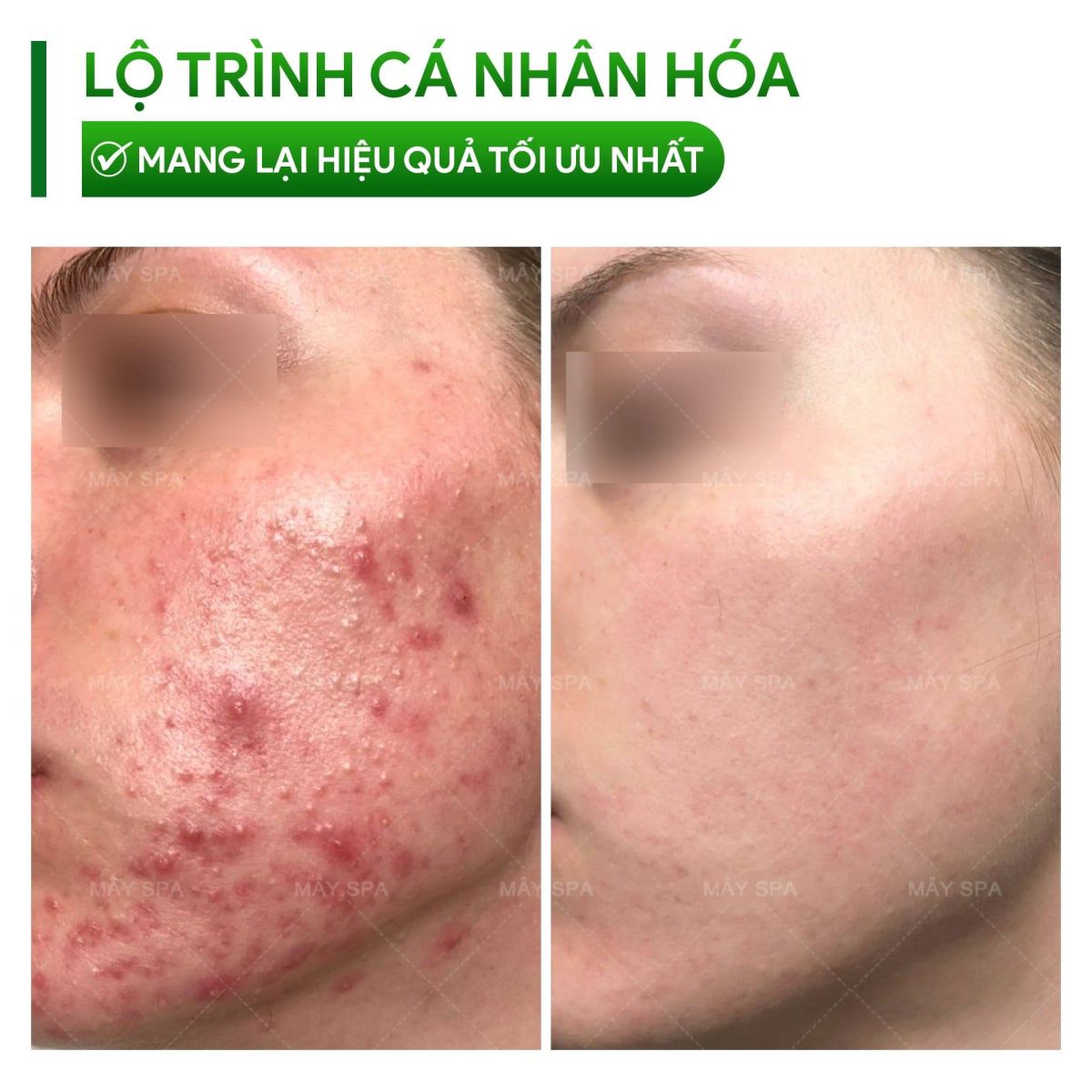 Review khách hàng thực tế điều trị mụn viêm với combo nặn mụn chuyên sâu + IPL