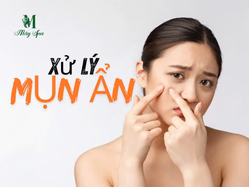 Xử lý mụn ẩn tại spa uy tín TpHCM