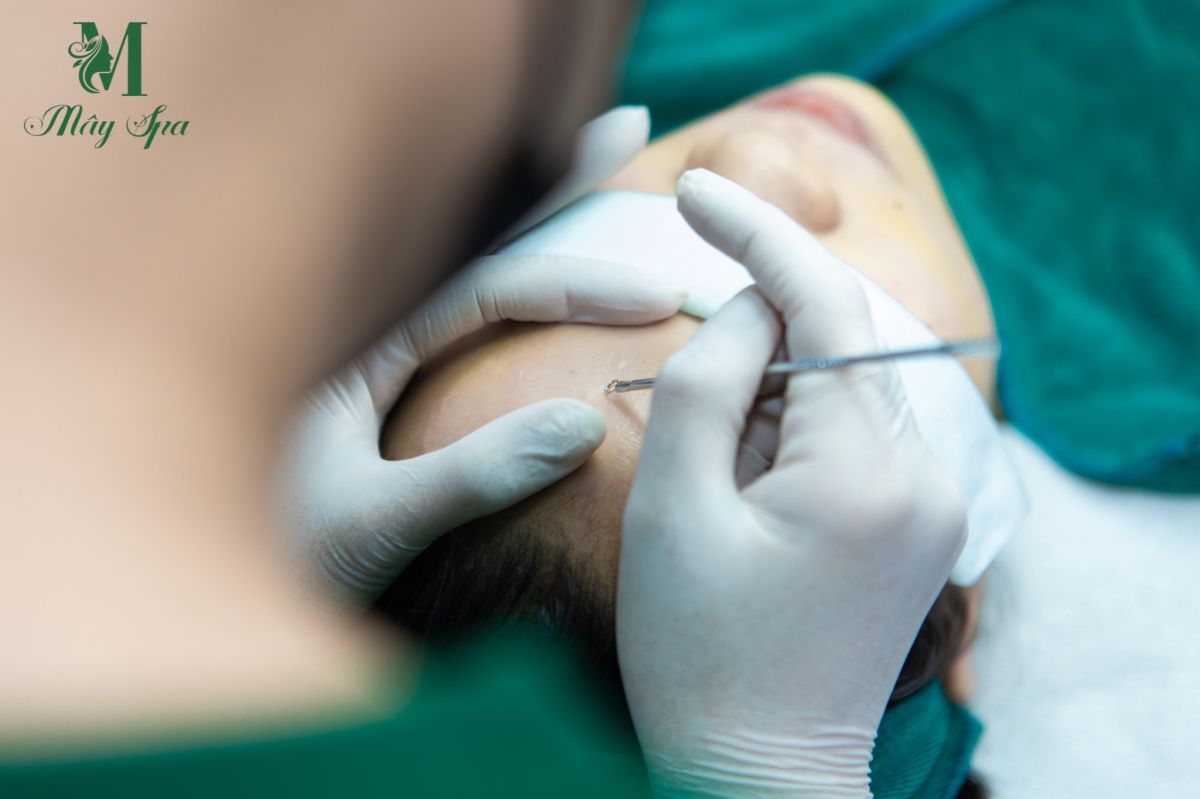 Mây spa Tân Phú là địa chỉ uy tín chuyên điều trị mụn bằng dược mỹ phẩm và đã nặn hàng ngàn ca mụn không để lại thâm sẹo