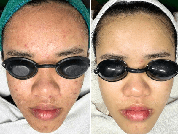 Kết quả sau 3 buổi điều trị mụn tại M&acirc;y spa T&acirc;n Ph&uacute;