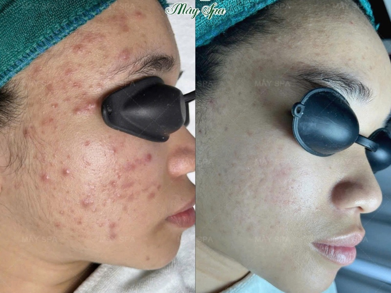 Kết quả liệu tr&igrave;nh trị mụn chuẩn y khoa tại M&acirc;y spa