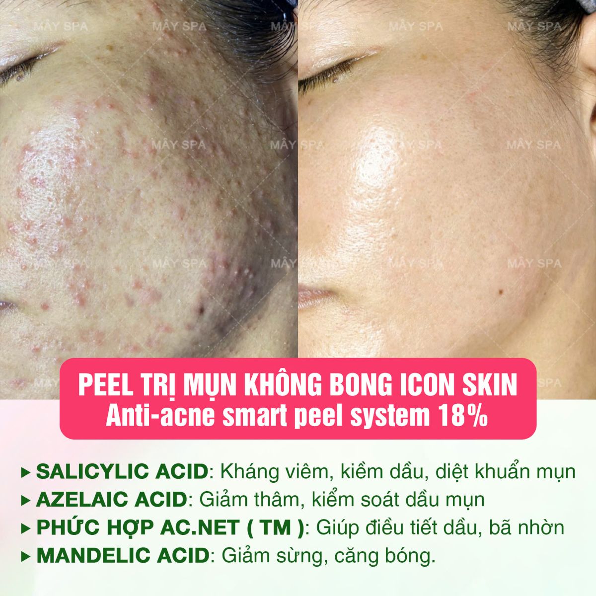 Kết quả sau liệu tr&igrave;nh Peel Icon Skin tại M&acirc;y Spa