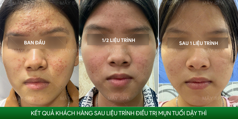 Kết quả điều trị mụn tại Mây spa Tân Phú sau nửa liệu trình