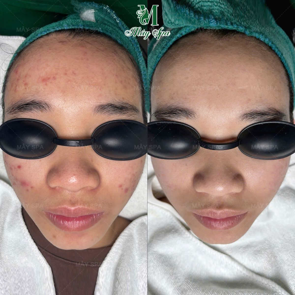 Kết quả trị mụn tại Mây spa