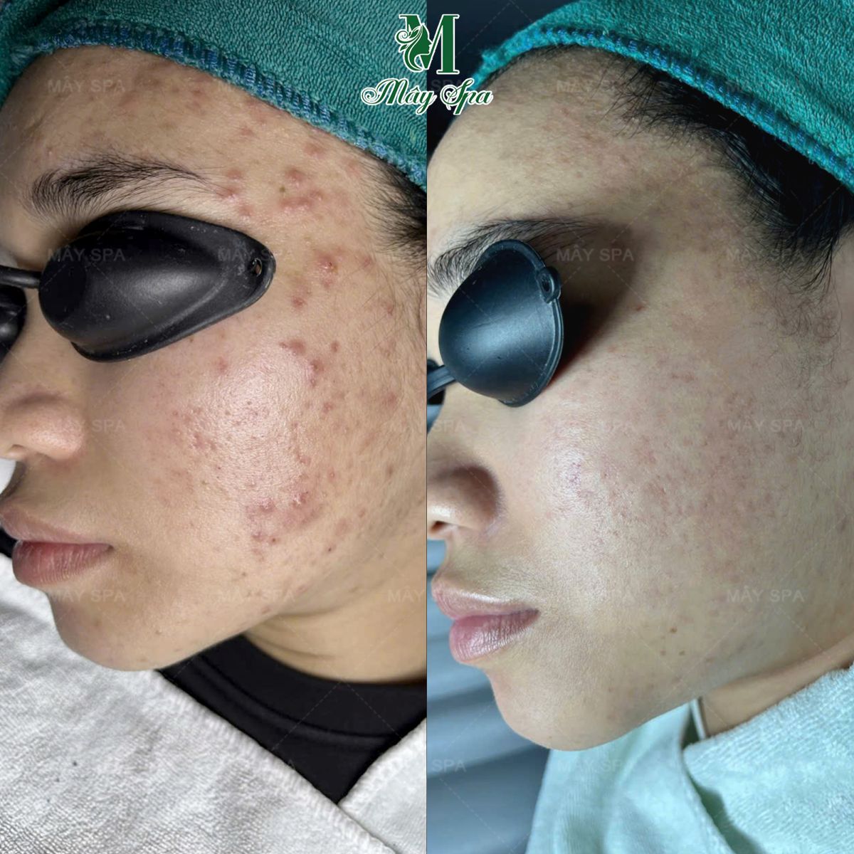 ket-qua-dieu-tri-mun-an-bang-chemical-peel