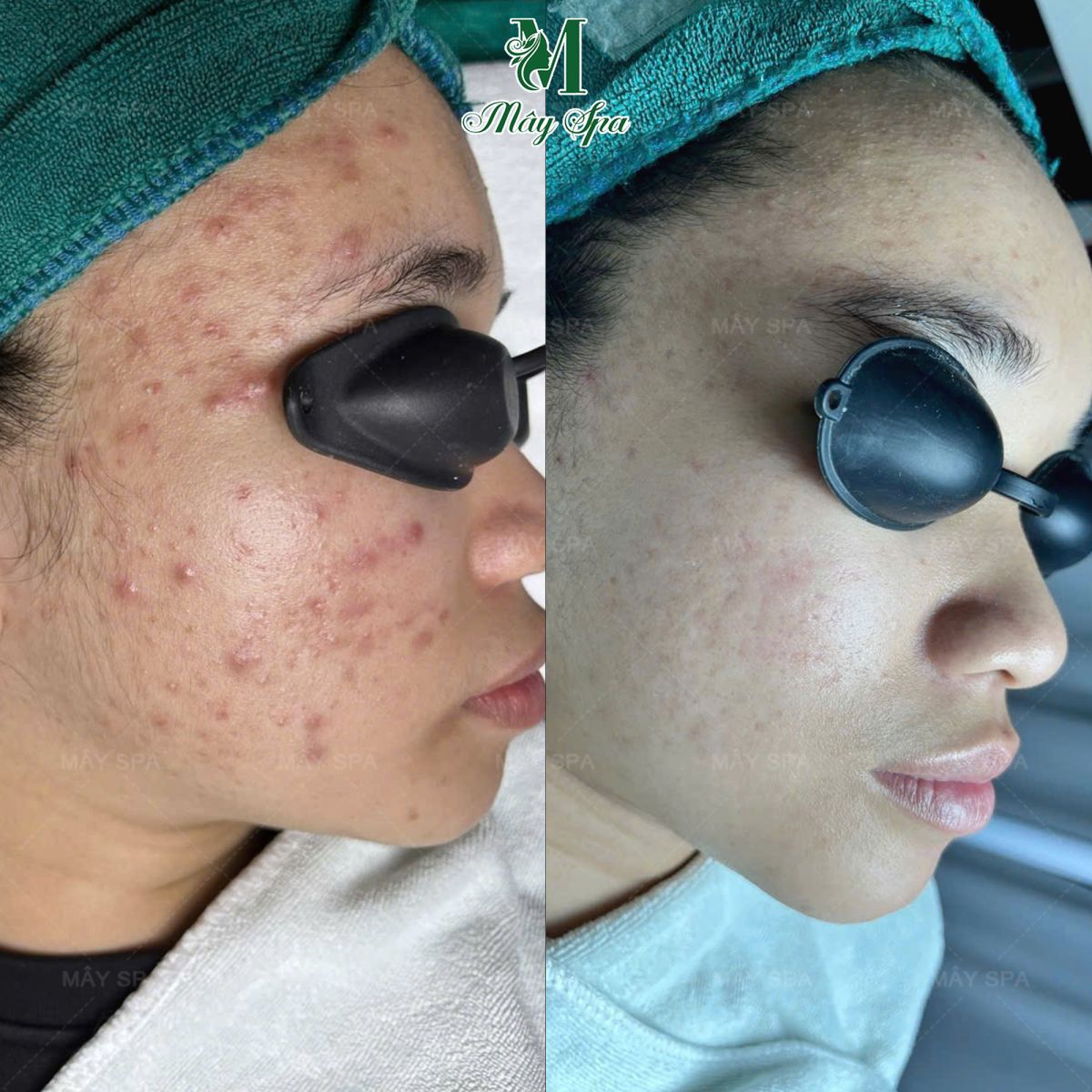 Kết quả sau 5 buổi chemical peel trị mụn tại Mây spa