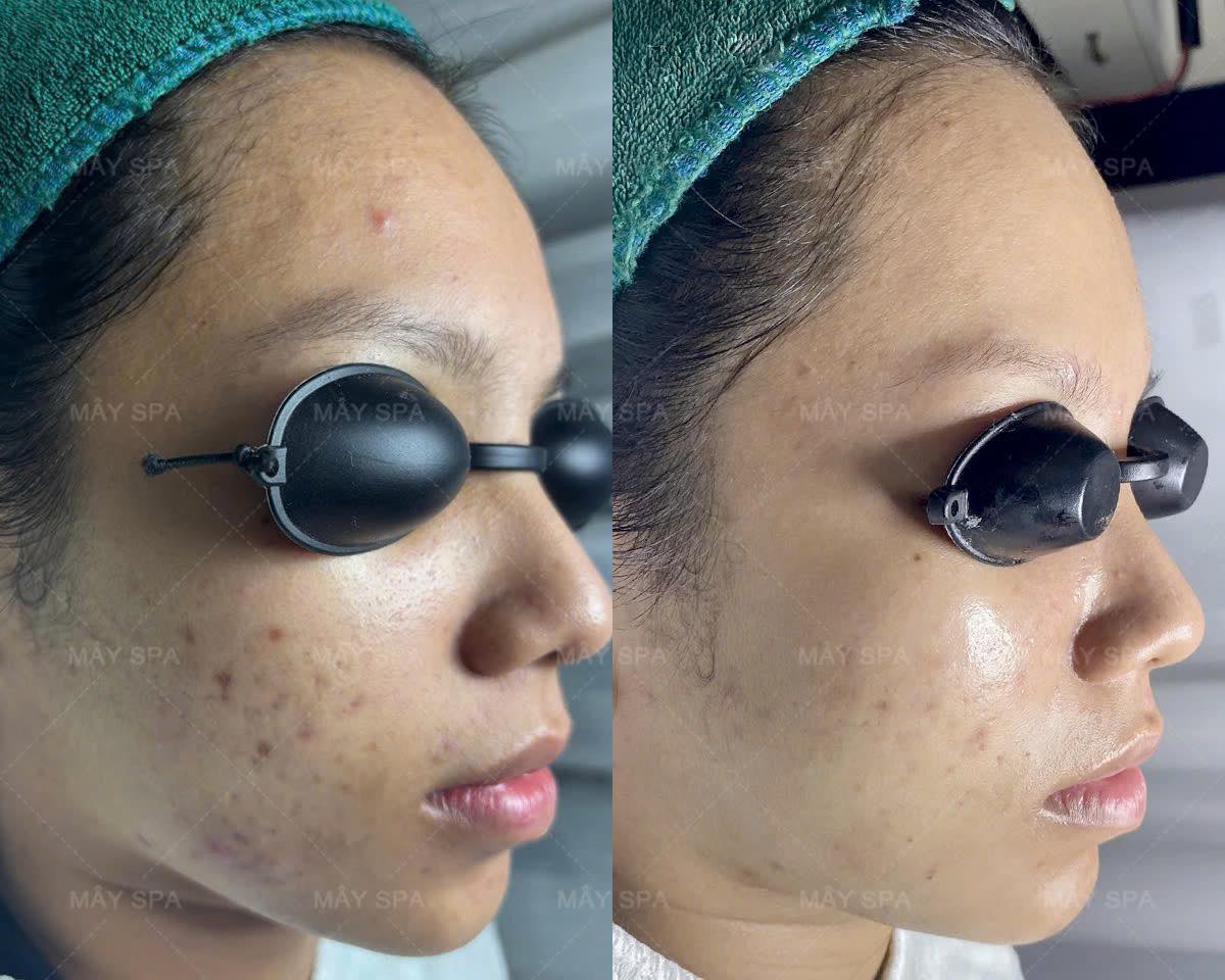 Kết quả khách đang trị mụn tại Mây Spa