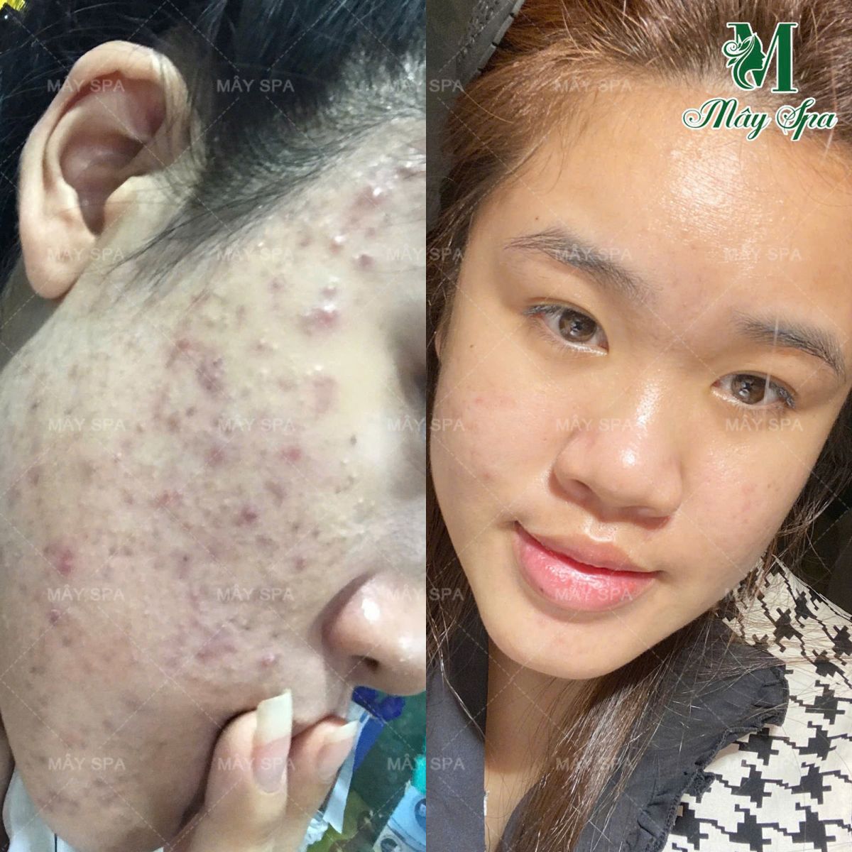 Kết quả trị mụn tại Mây spa