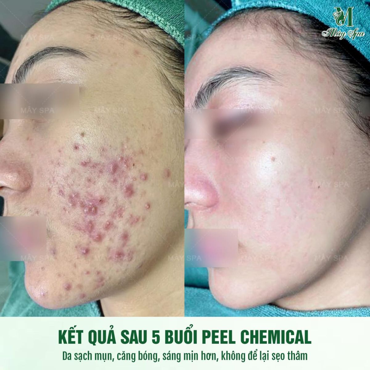 Kết quả Peel da trị thâm mụn tại spa uy tín - Mây spa