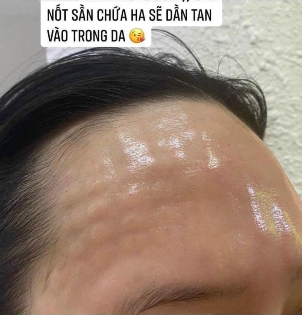 các nốt sần sẽ tan trong 24 giờ