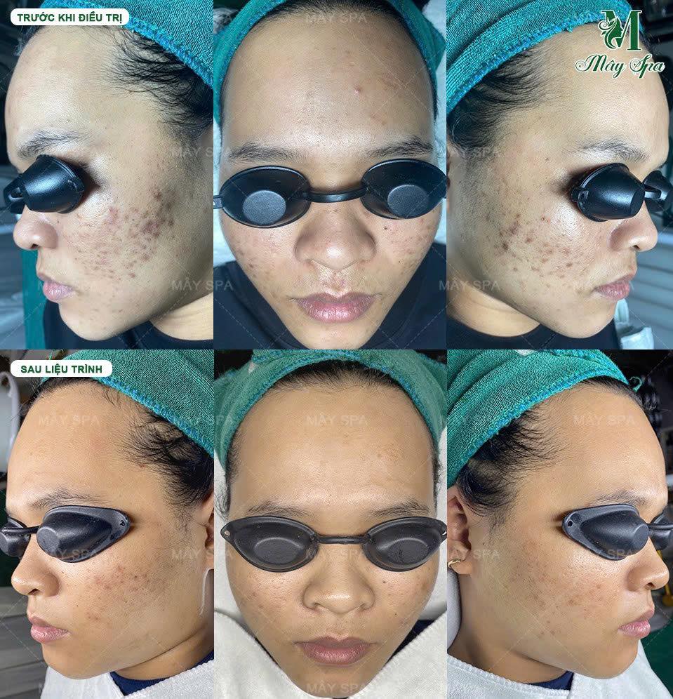 Kết quả liệu trình trị mụn bằng Chemical Peel