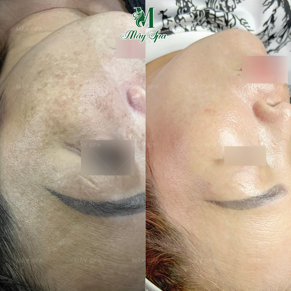 Kết quả Peel da trị n&aacute;m