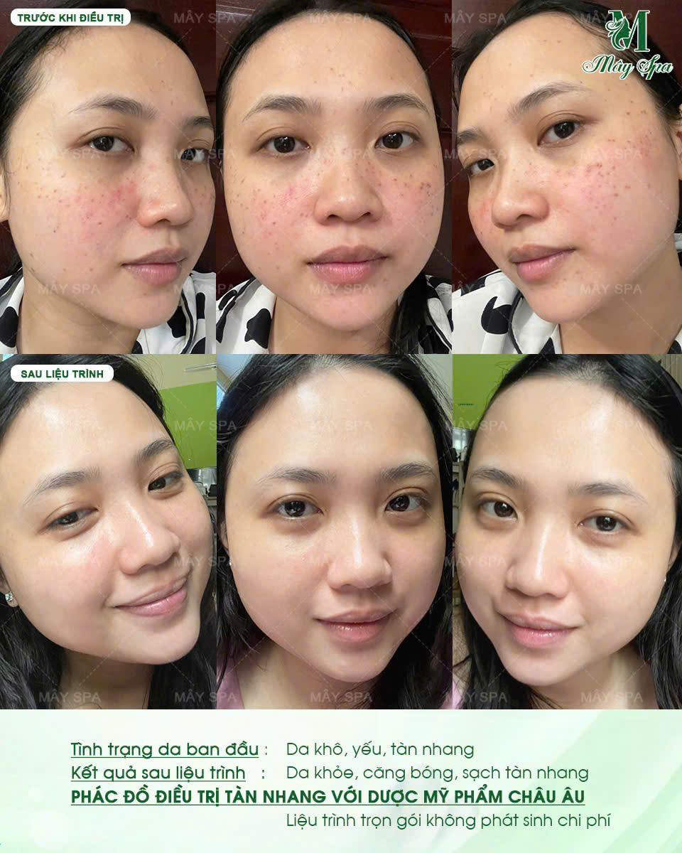 Kết quả peel da trị t&agrave;n nhang tại M&acirc;y spa T&acirc;n Ph&uacute;