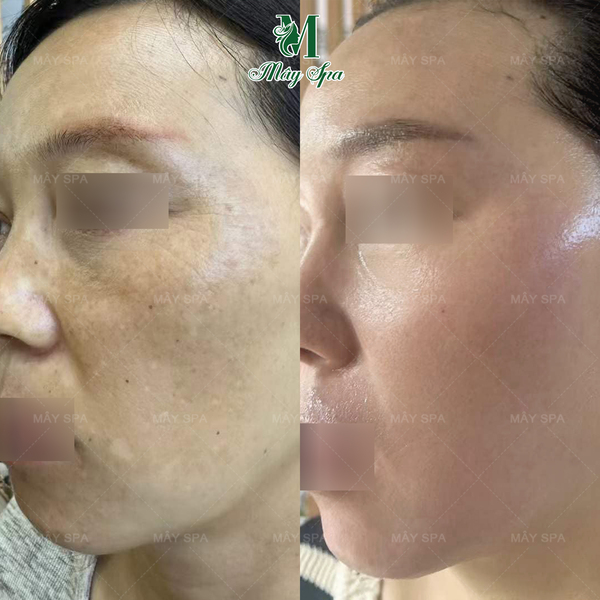 feed back peel da trị n&aacute;m