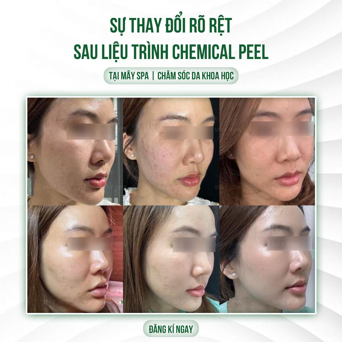 Kết quả sau liệu trình Peel da trị thâm tại Mây spa