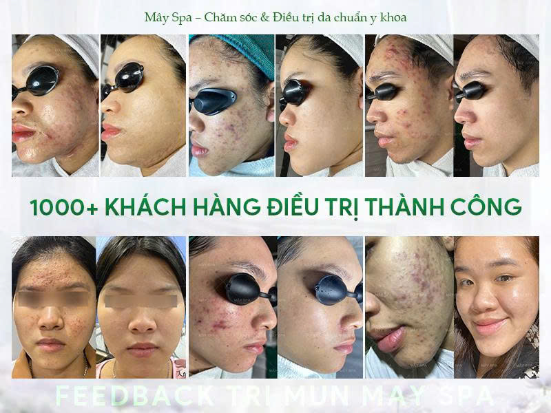 Kết quả điều trị mụn tại M&acirc;y spa T&acirc;n Ph&uacute;