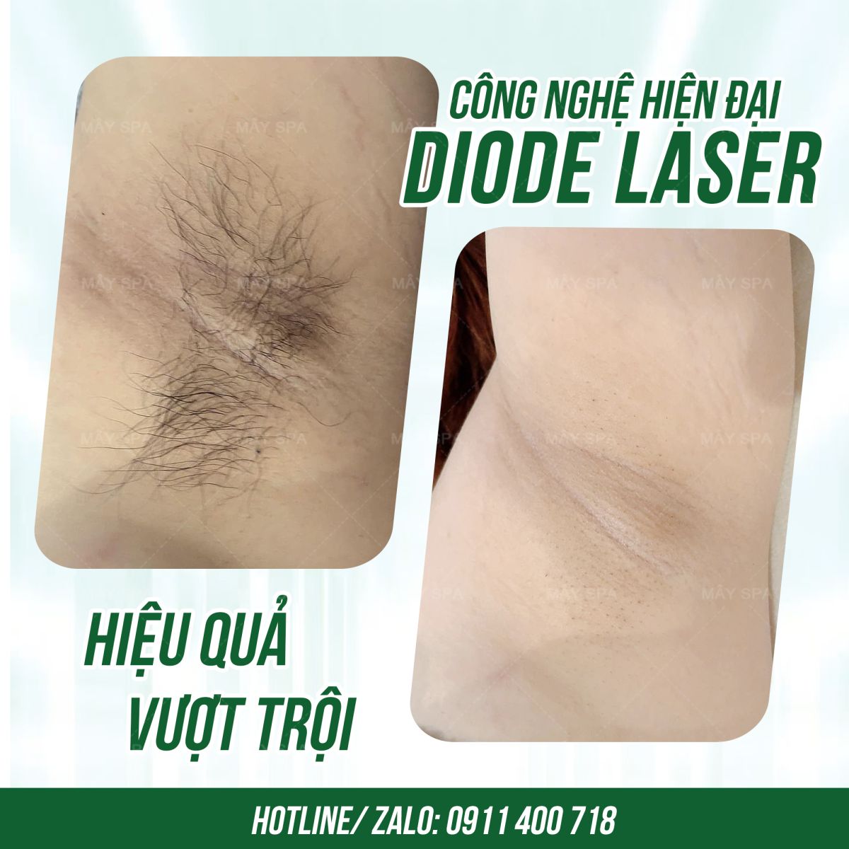 Triệt lông vĩnh viễn công nghệ Diodes Laser - Hiệu quả và tiết kiệm