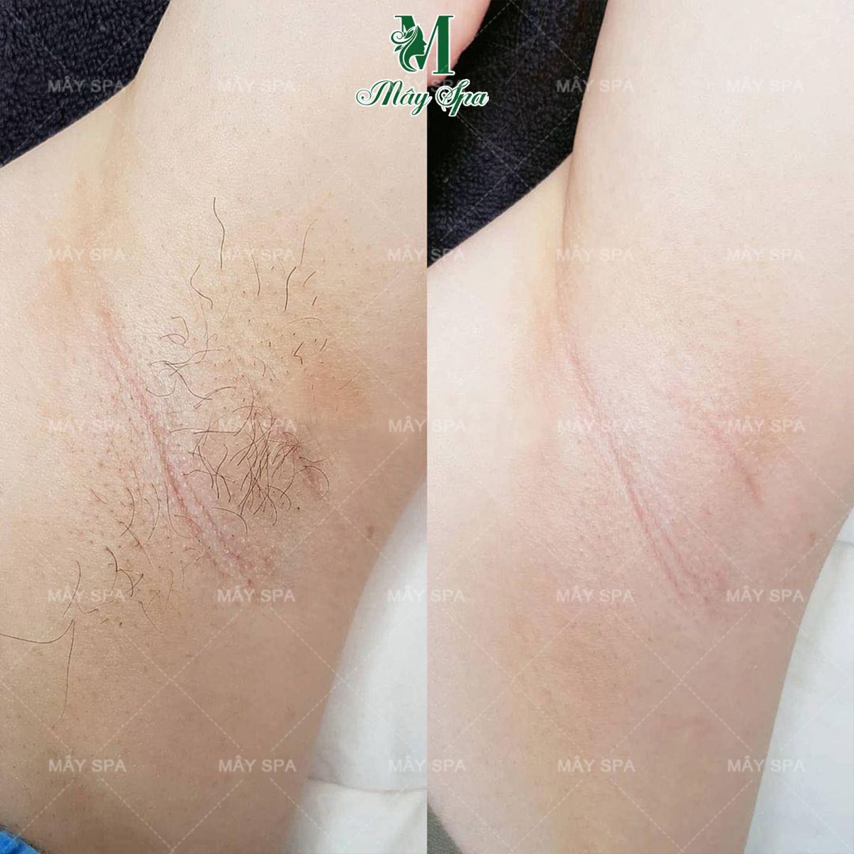 Hiệu quả triệt rõ ràng sau liệu trình