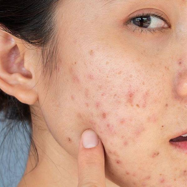 Cách trị mụn ẩn dưới da an toàn và hiệu quả – Giải pháp chuẩn y khoa | Mây Spa