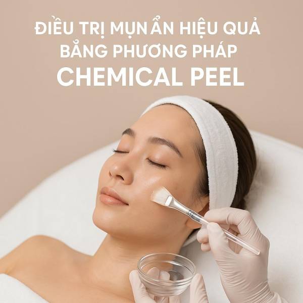 Điều Trị Mụn Ẩn Hiệu Quả Bằng Phương Pháp Chemical Peel – Làn Da Sạch Mịn Chỉ Sau Vài Buổi | Mây Spa