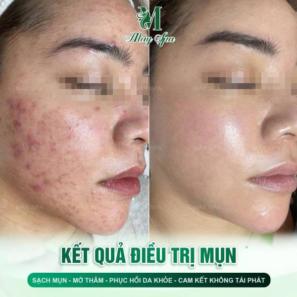 Peel da trị mụn - Giải pháp trị mụn hiệu quả | Mây Spa Peel da trị mụn - Giải pháp trị mụn hiệu quả | Mây Spa