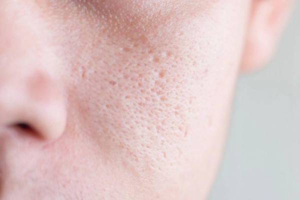 Liệu Trình Peel Da Thu Hẹp Lỗ Chân Lông To Liệu Trình Peel Da Thu Hẹp Lỗ Chân Lông To