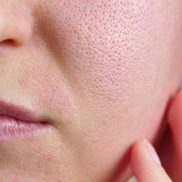 Lỗ chân lông to: Nguyên nhân và các phương pháp se khít hiệu quả tại spa