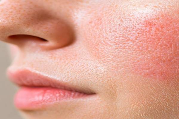 Da dầu lỗ chân lông to: Nguyên nhân & cách khắc phục hiệu quả Da dầu lỗ chân lông to: Nguyên nhân & cách khắc phục hiệu quả