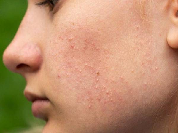 Mụn ẩn có nên nặn không? Cách nặn mụn ẩn ít đau