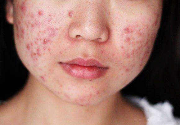 Mụn Viêm Gây Nguy Hại Cho Da Như Thế Nào? Mụn Viêm Gây Nguy Hại Cho Da Như Thế Nào?