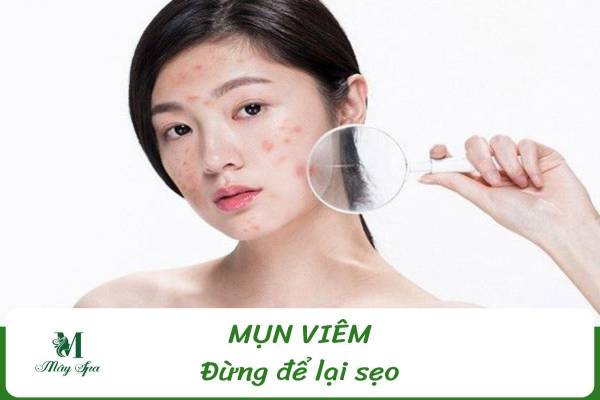 Điều Trị Mụn Viêm Cho Gen Z: Đừng Để Mụn Đỏ Sưng Biến Thành Sẹo