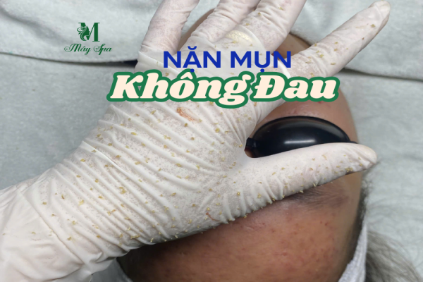 Nặn mụn không đau – Deep Clean Skin – Trải nghiệm xứng đáng tại spa uy tín