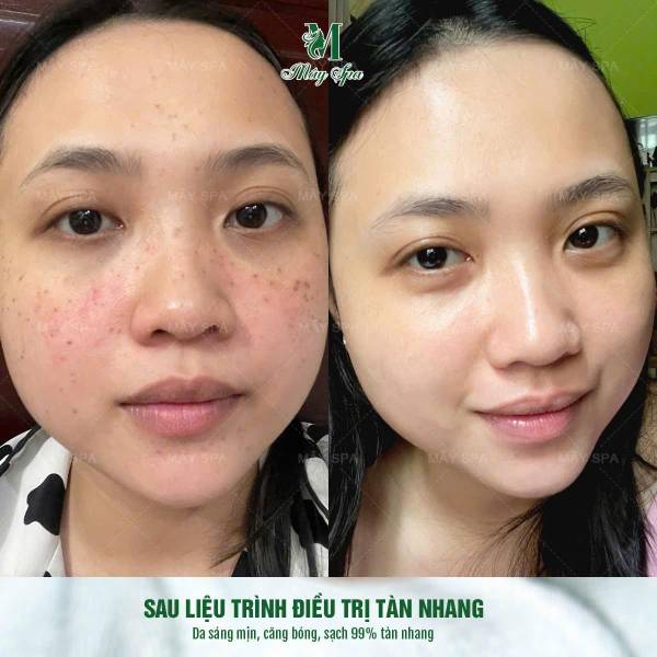 Chữa Tàn Nhang Bằng Phương Pháp Peel Da – Giải Pháp Hiệu Quả Cho Làn Da Sáng Mịn | Mây Spa Chữa Tàn Nhang Bằng Phương Pháp Peel Da – Giải Pháp Hiệu Quả Cho Làn Da Sáng Mịn | Mây Spa