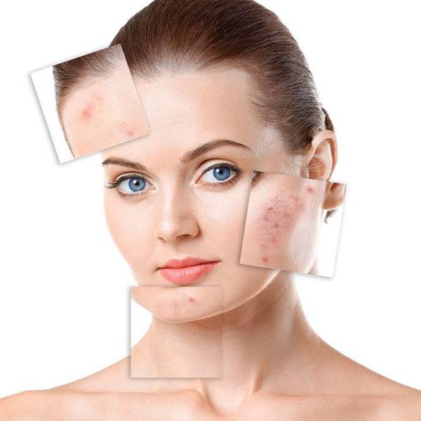 Peel da có thực sự hết mụn không? Chuyên gia giải đáp chi tiết | Mây Spa