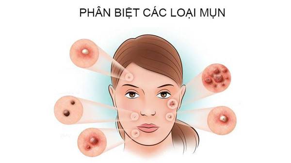 Mụn Đầu Đen, Mụn Ẩn, Mụn Viêm – Phân Biệt Và Cách Xử Lý Hiệu Quả | Mây Spa