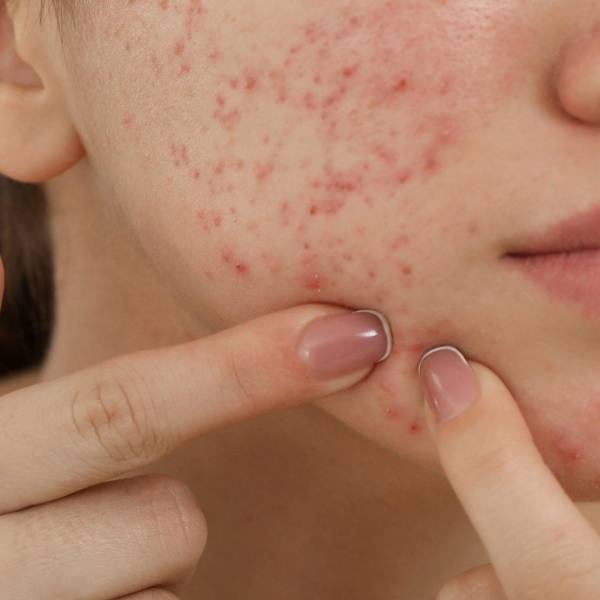 Chăm sóc da mụn giá sinh viên tại Spa Tân Phú | Mây Spa