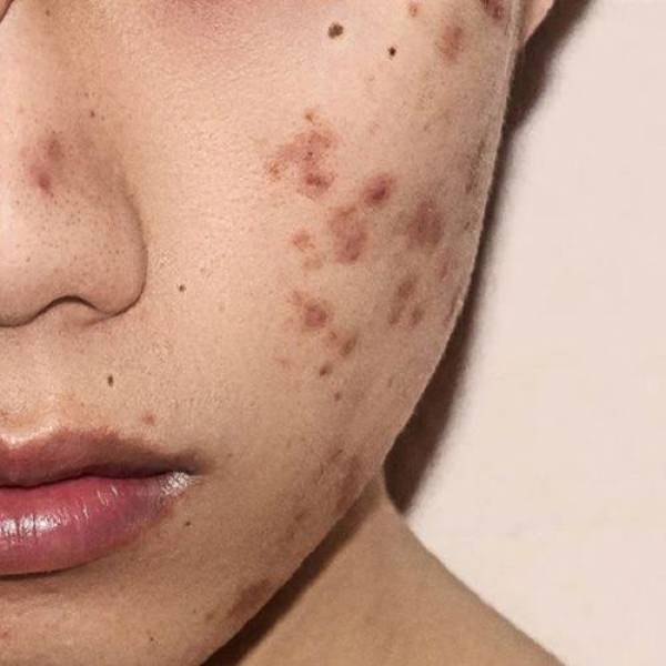 Trị thâm mụn – Liệu trình Peel da chuẩn y khoa | Mây Spa Trị thâm mụn – Liệu trình Peel da chuẩn y khoa | Mây Spa