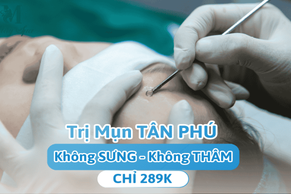 ĐIỀU TRỊ MỤN TẬN GỐC TẠI TÂN PHÚ – CHỈ 289K (TRỌN GÓI)