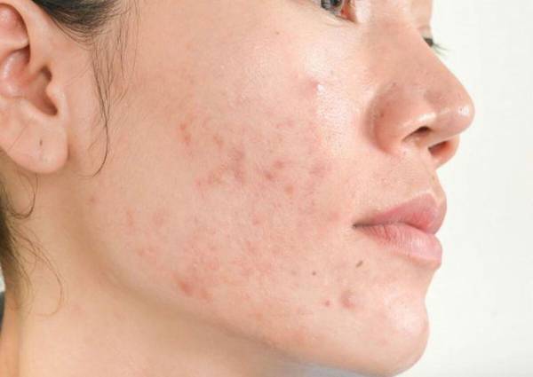 Các loại mụn thường được chỉ định lấy nhân mụn tại spa y khoa